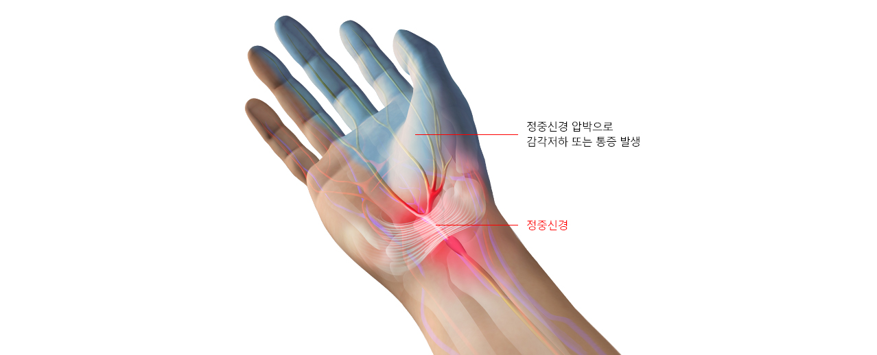 손목터널증후군