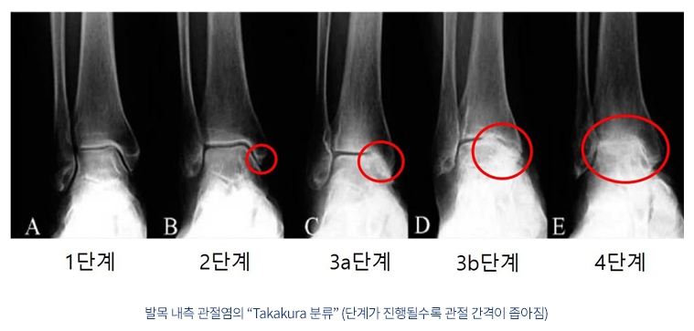 발목의 관절염 증상