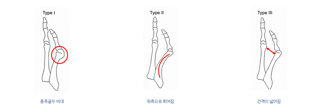 소족지 건막류 증상