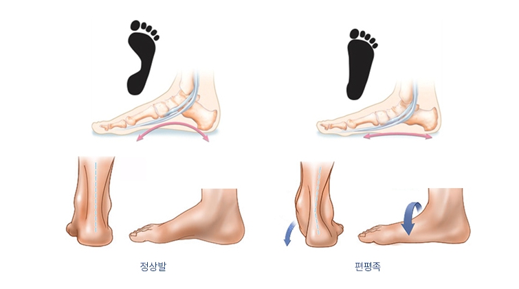 평발 증상